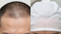 comparison of hair loss treatments