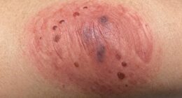 ipl side effects explained