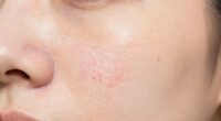 skin marks from pore vacuums